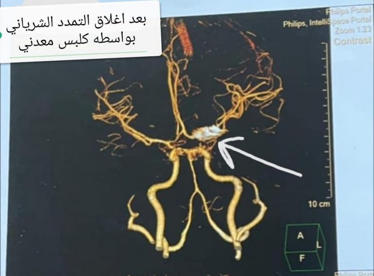 مستشفي سوهاج الجامعي تجري 5 عمليات ميكروسكوبيه لعلاج التمددات الشريانية