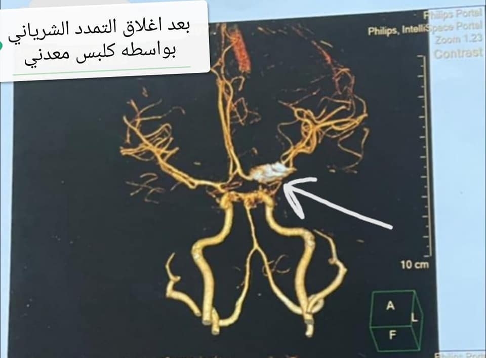 مستشفي سوهاج الجامعي تجري 5 عمليات ميكروسكوبيه لعلاج التمددات الشريانية